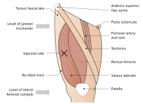 Anatomical-markers-vastus-lateralis-injection-anterolateral-thigh-HR.png